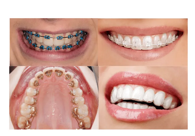 aparat ortodontyczny ceramiczny i szafirowy porównanie