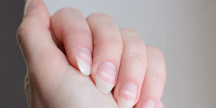 paznokcie łyżeczkowate koilonychia