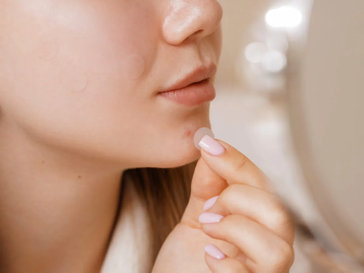 cykl powstawania pryszcza