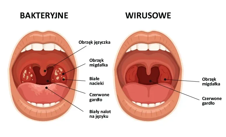 Objawy anginy i silnego bólu gardła