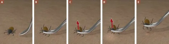 jak usunąć kleszcza pęsetą