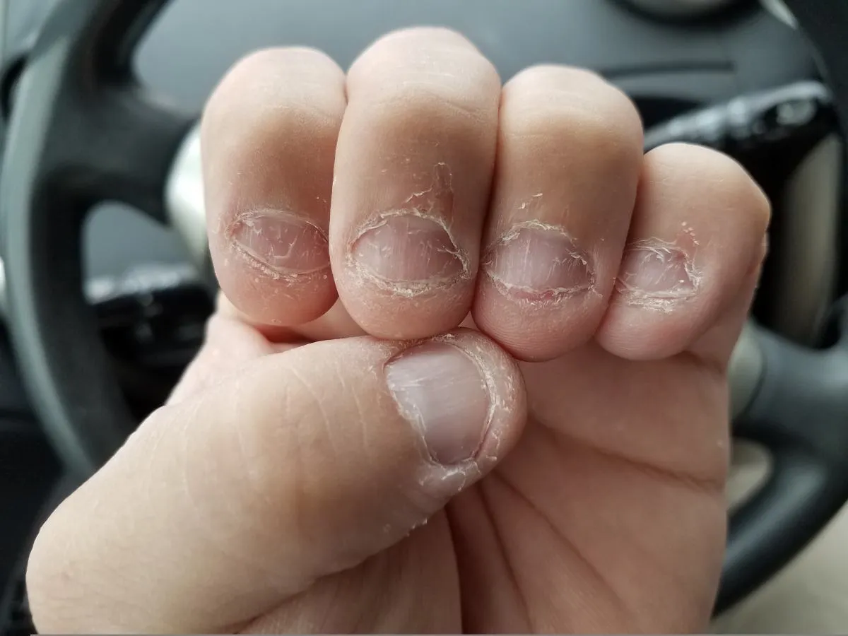 uszkodzone paznokcie od obgryzania u dziecka