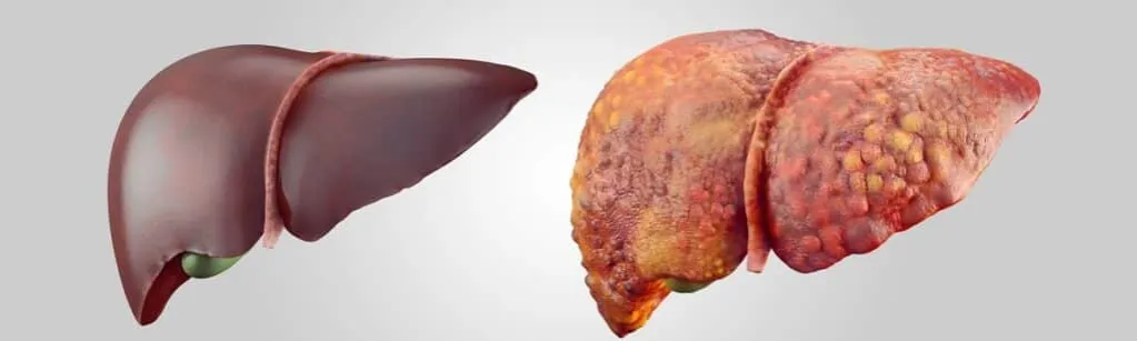 Wątroba człowieka, uszkodzona wątroba, stłuszczenie wątroby
