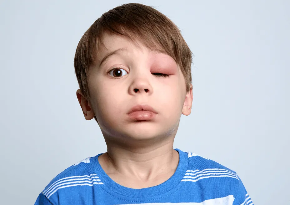 obrzęk naczynioruchowy u dziecka