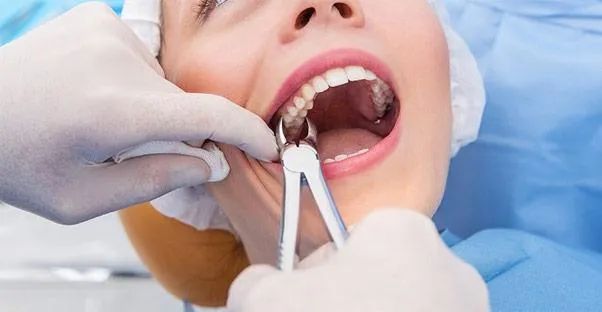 chirurgia stomatologiczna, ekstrakcja &oacute;semki