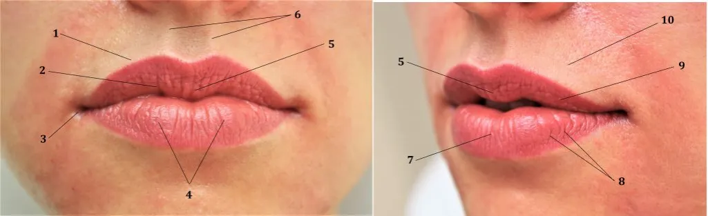 powiększanie ust kwasem hialuronowym schemat