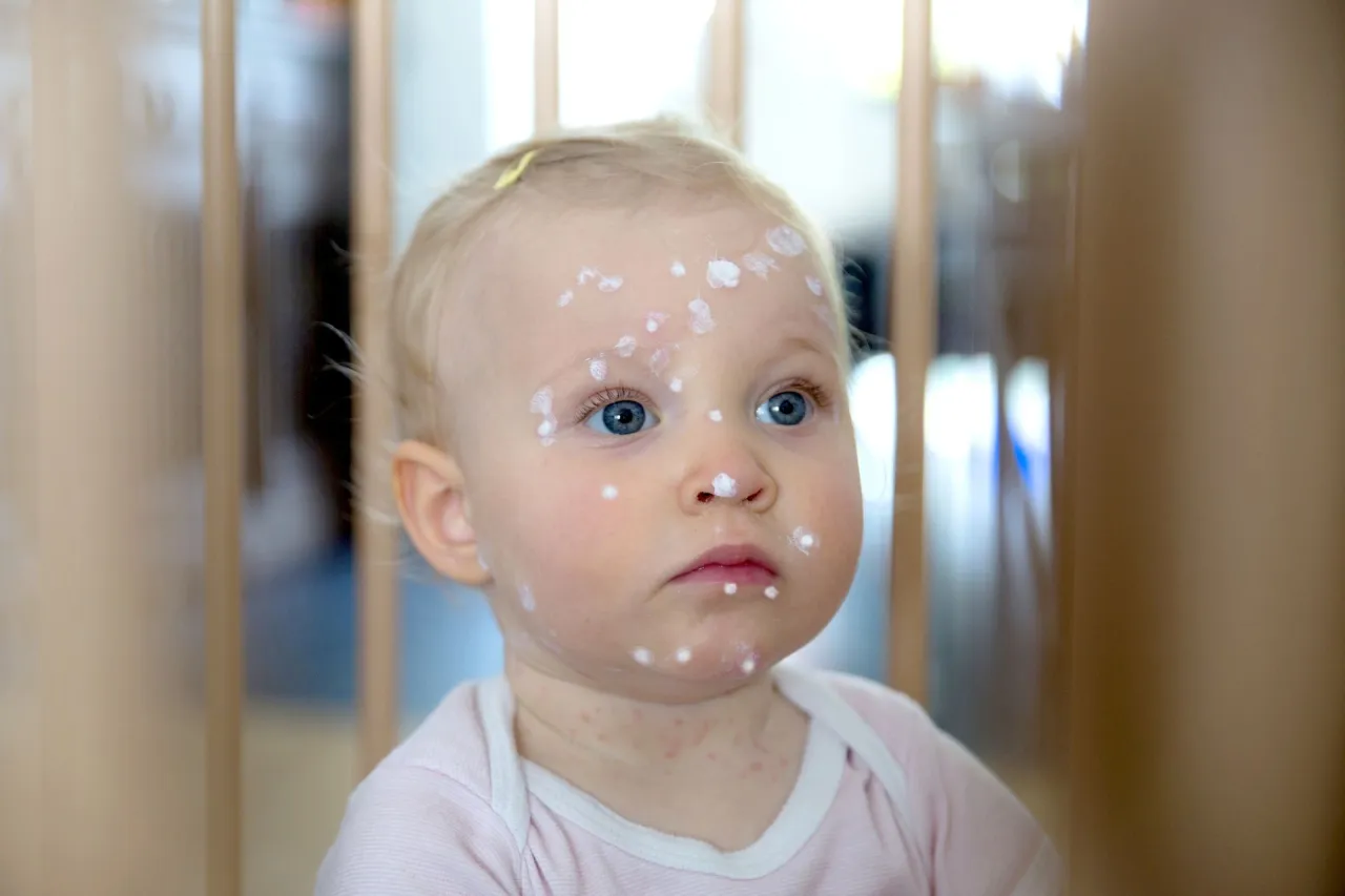 dziecko w kąpieli z ospą wietrzną