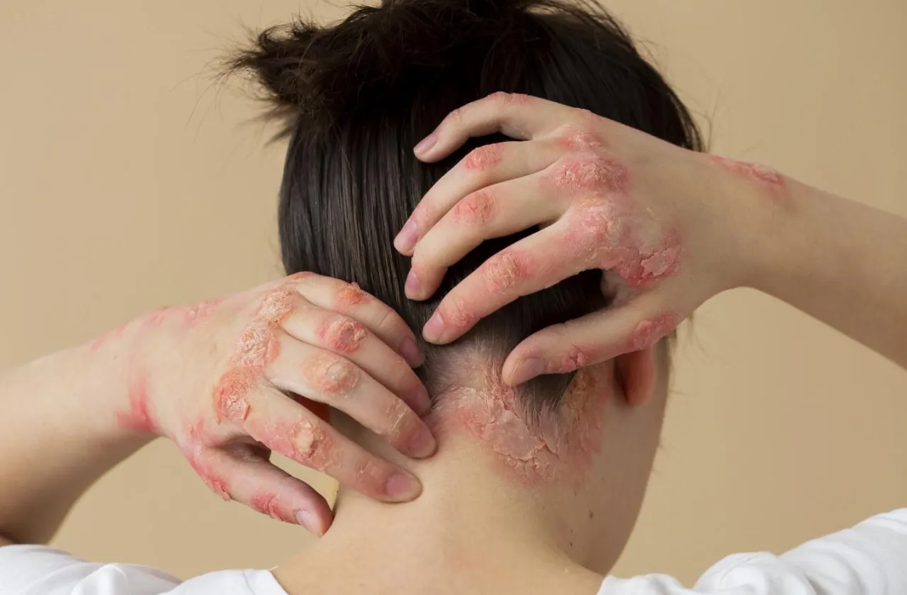 Rozmowa z dermatologiem o izotretynoinie i samopoczuciu