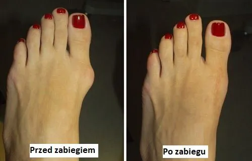 Koszt operacji haluksa prywatnie