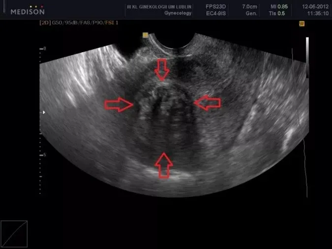 Mięśniaki macicy USG