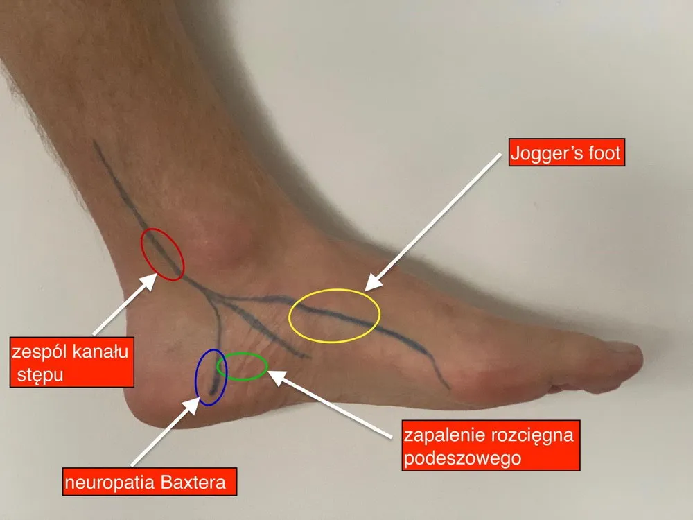 biegacz z b&oacute;lem śr&oacute;dstopia, anatomia stopy