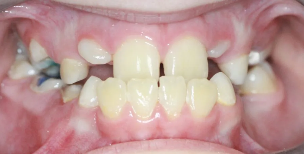 dziecko z krzywymi zębami, rodzic ortodonta