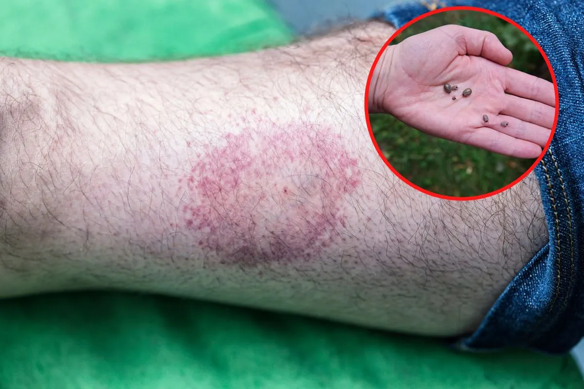 Rumień wędrujący borelioza tarcza strzelnicza