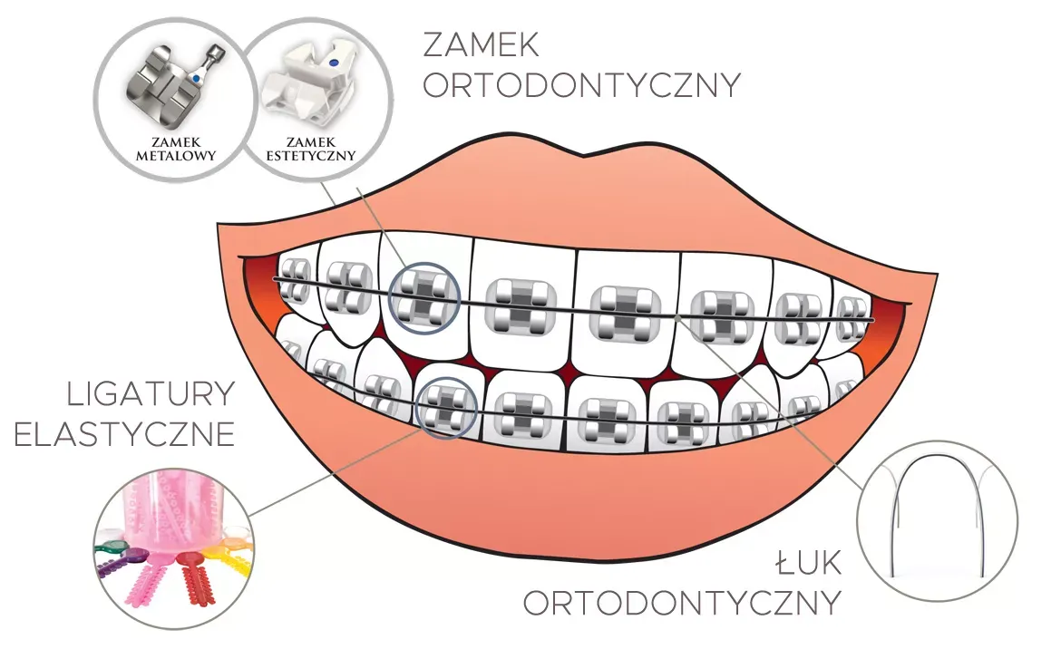 etapy leczenia ortodontycznego