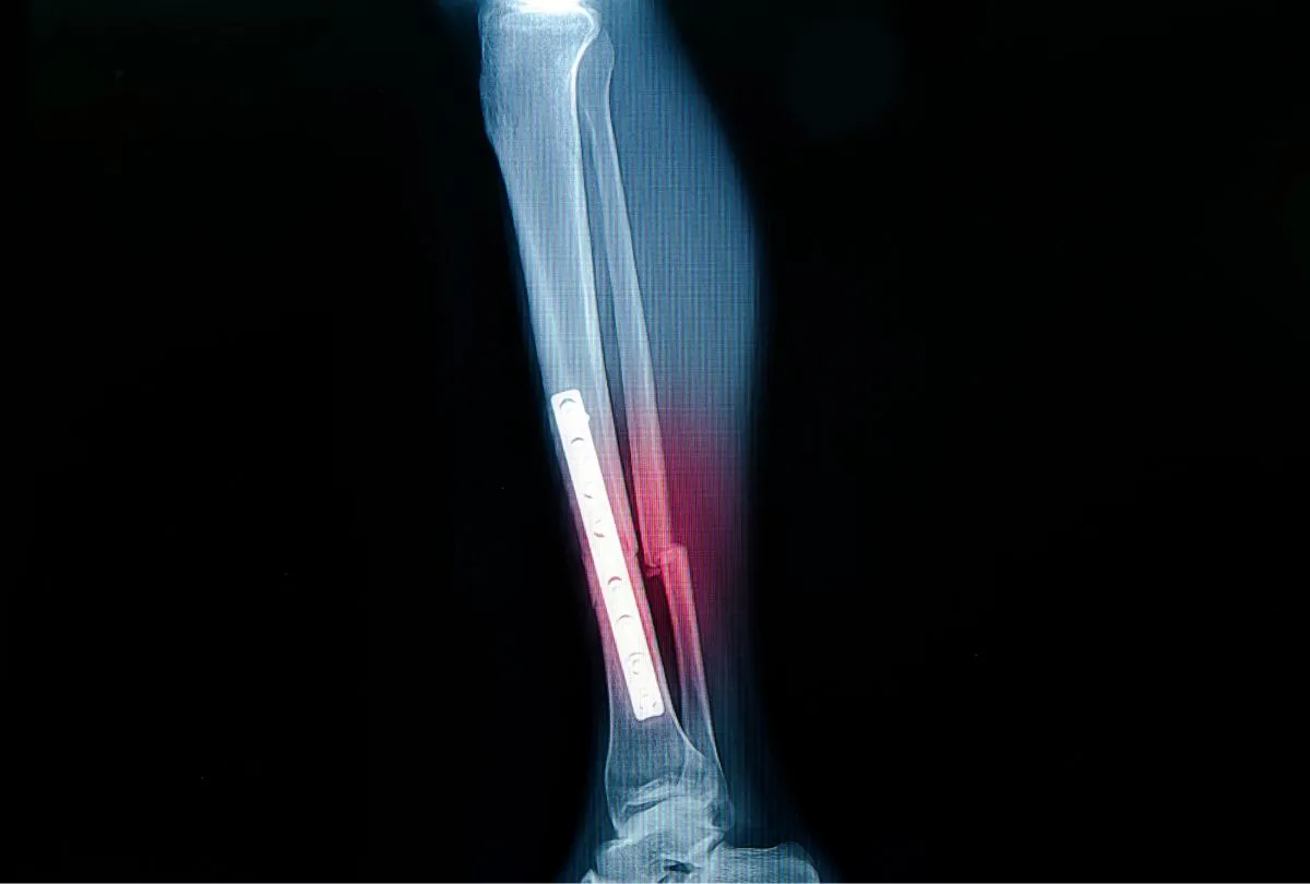 RTG pokazuje zespolenie złamania kości strzałkowej z użyciem płytki i śrub.