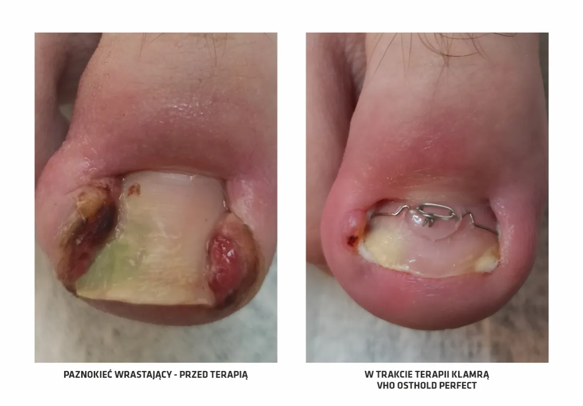 wrastający paznokieć objawy stadia