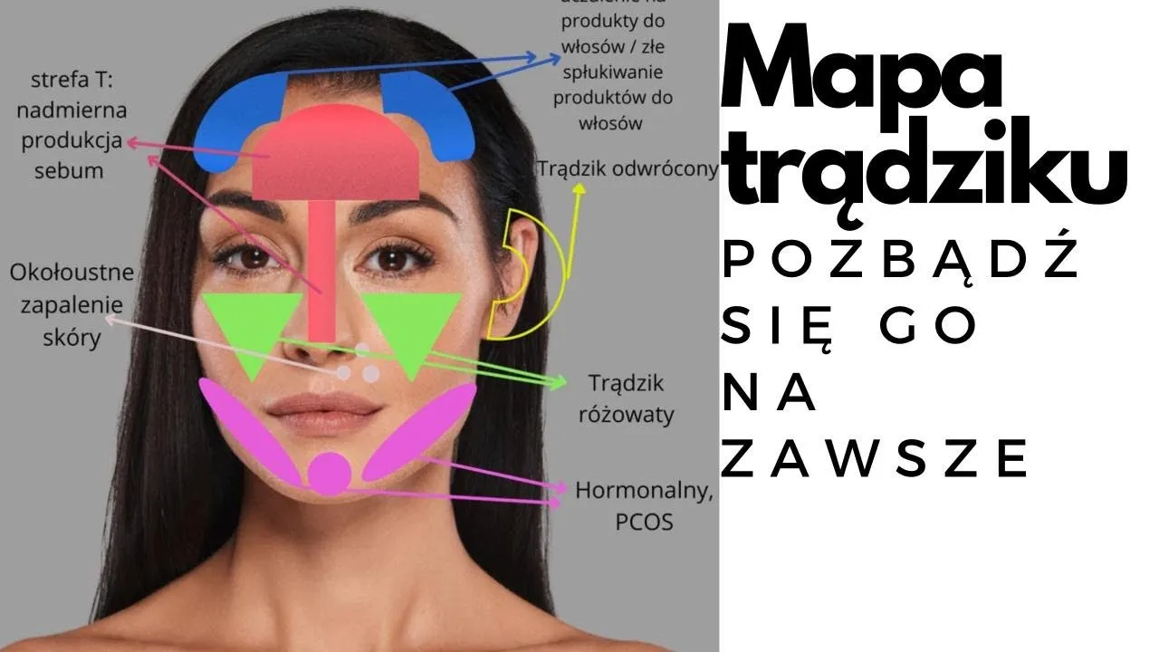 Mapa pryszczy na szyi, strefy trądziku na szyi