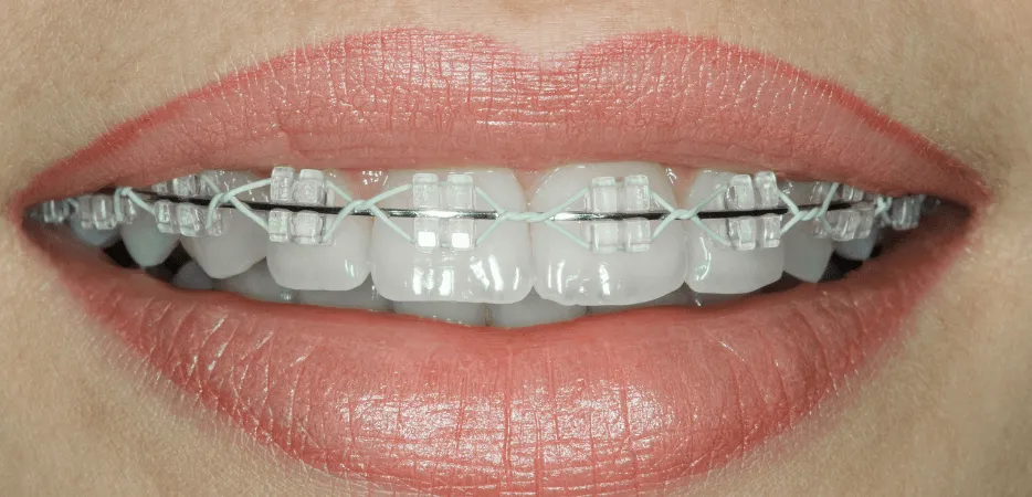 różne rodzaje aparatów ortodontycznych, aparat metalowy, aparat ceramiczny, aparat szafirowy