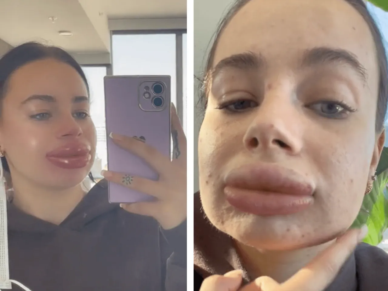 Uśmiechnięta kobieta po zabiegu powiększania ust, bez widocznego bólu