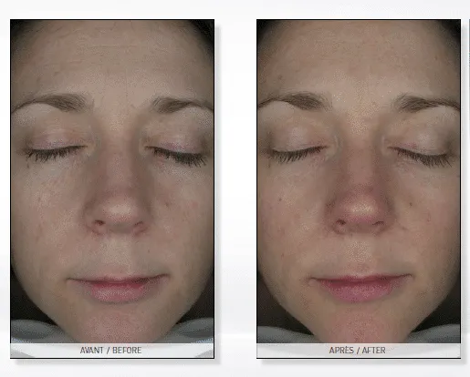 cennik endermologii twarzy lpg alliance