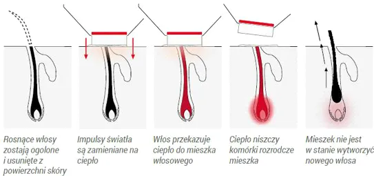 schemat działania lasera na włos
