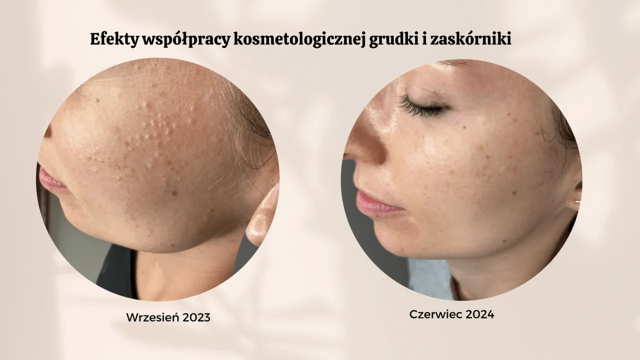 Sk&oacute;ra trądzikowa pory zask&oacute;rniki