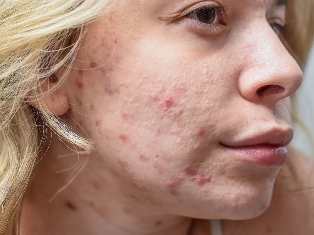 rozrapany pryszcz dezynfekcja