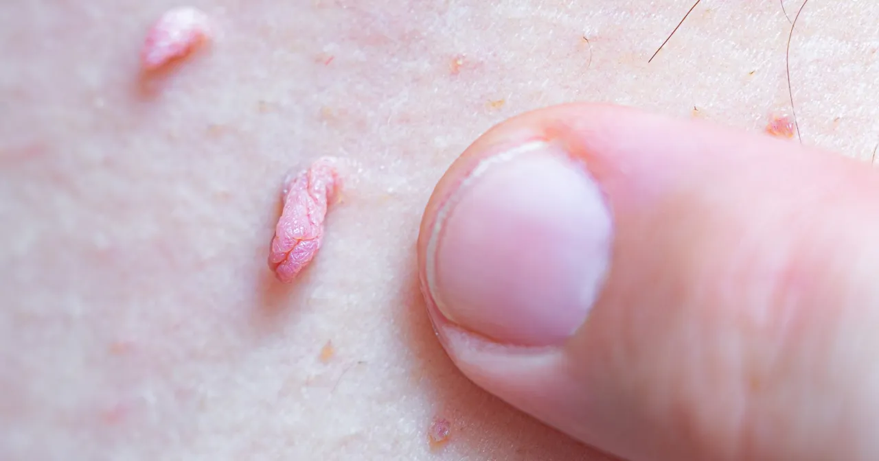 nietypowe zmiany narząd&oacute;w płciowych a rak