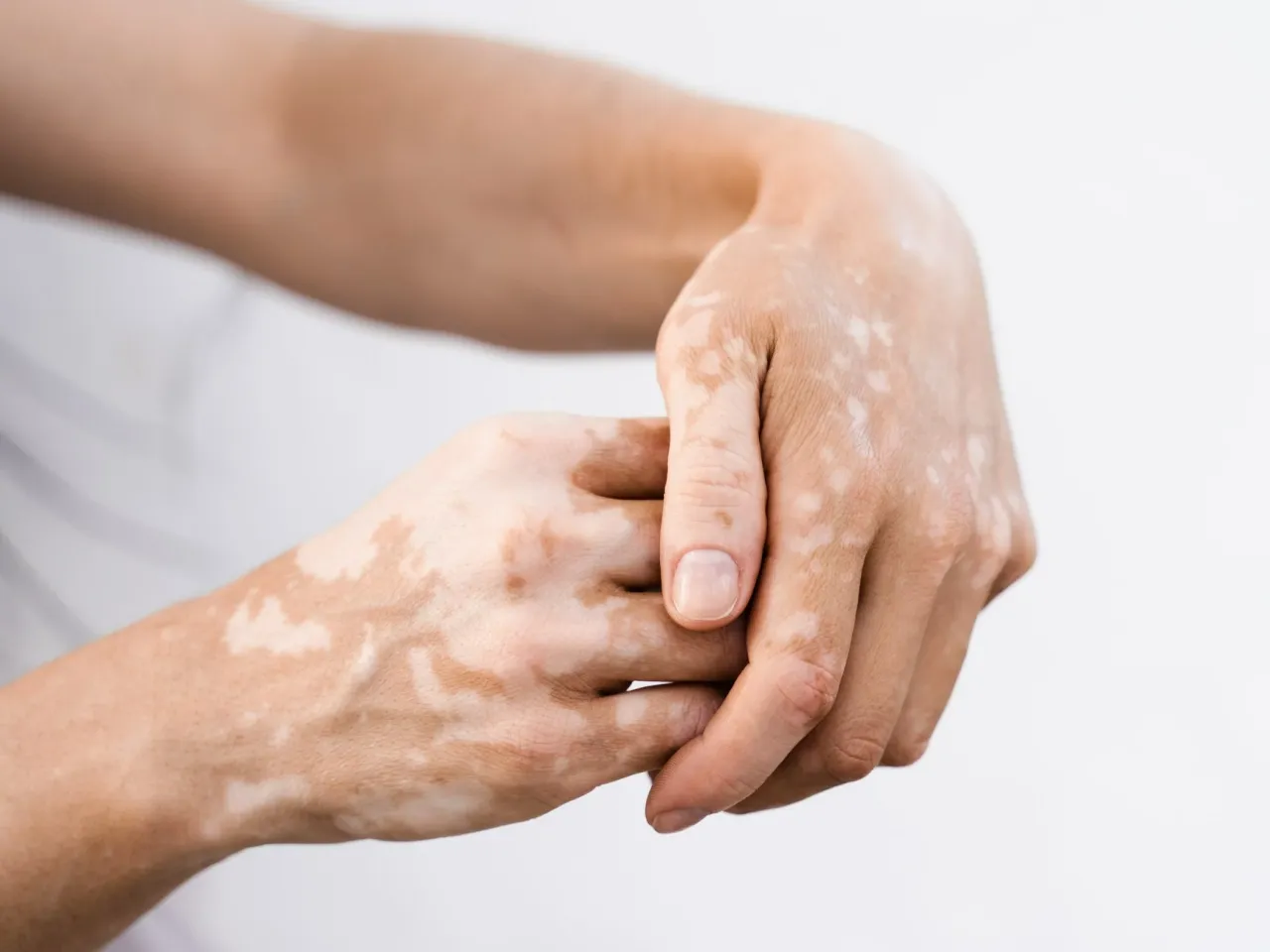 Dłonie i przedramiona z widocznymi białymi plamami na skórze, tworzącymi unikalny wzór.