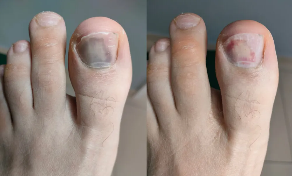 pierwsza pomoc krwiak pod paznokciem