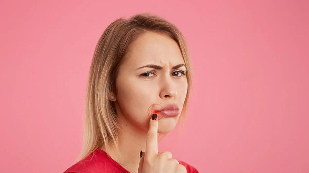 Zdjęcie Skuteczne sposoby na pryszcz na ustach – jak się pozbyć problemu?