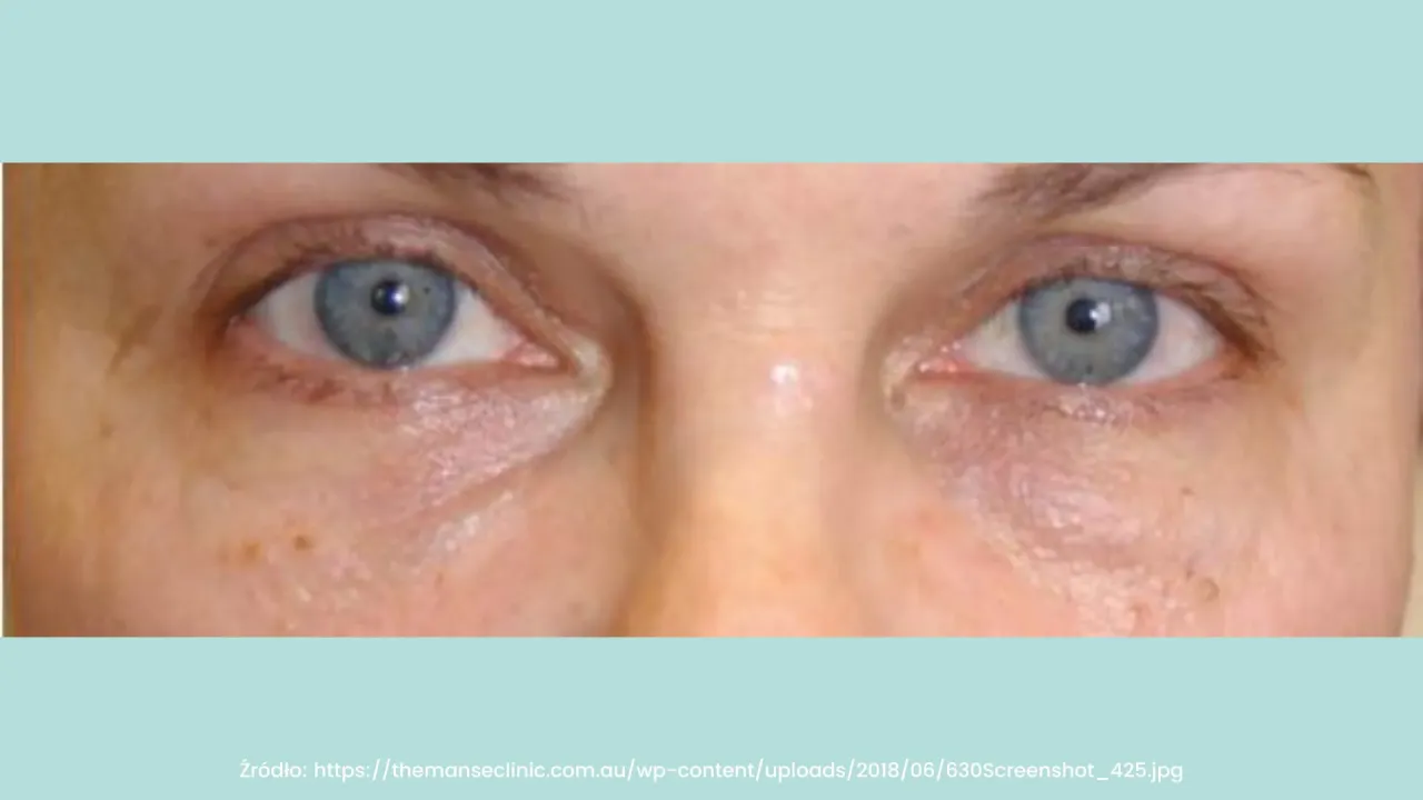 efekt Tyndalla pod oczami po kwasie hialuronowym