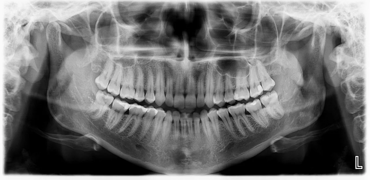 Zdjęcie rentgenowskie zęb&oacute;w pantomograficzne
