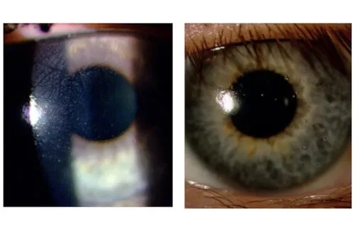 osady białkowe na soczewce kontaktowej