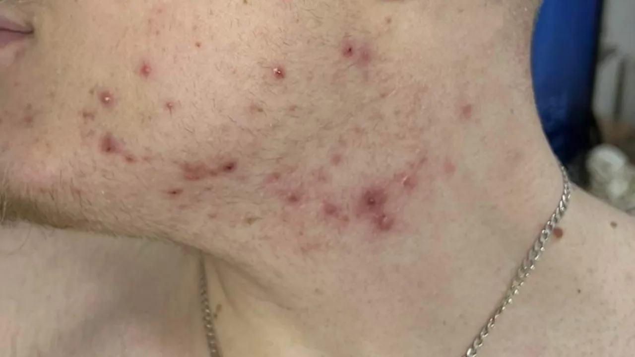 higiena telefonu i poduszki trądzik