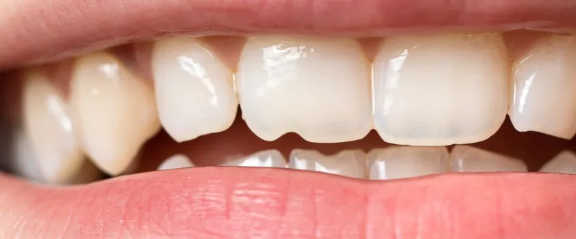 Uszkodzone szkliwo zębów powiększenie