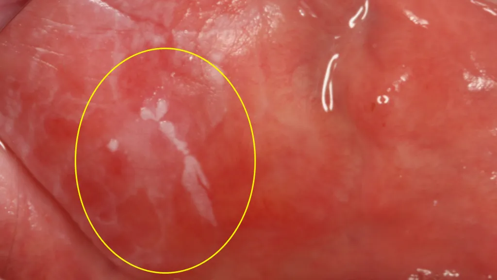 rak jamy ustnej wczesne objawy zdjęcia, leukoplakia erytroplakia