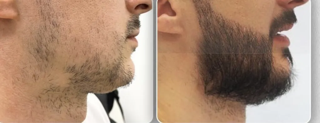 przed i po przeszczepie brody