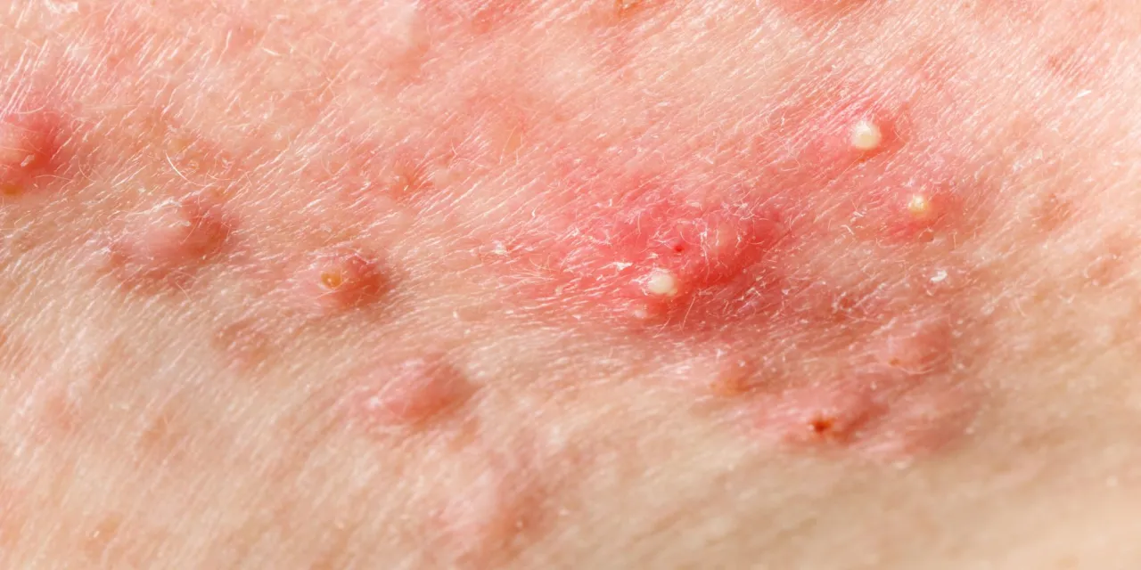 Widok z bliska na skórę z ropnymi pryszczami. Dowiedz się, jak pozbyć się ropnego pryszcza i przywrócić cerze zdrowy wygląd.