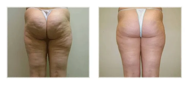 porównanie zabiegów antycellulitowych