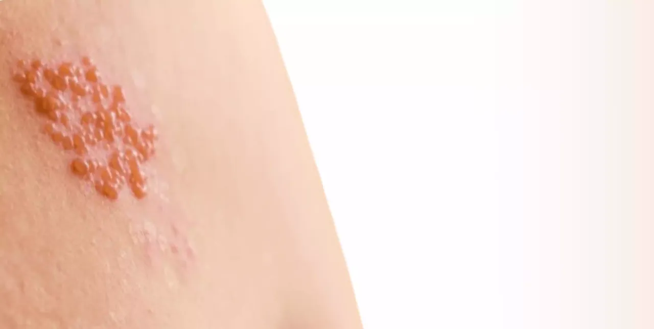 Półpasiec u osób starszych i z obniżoną odpornością