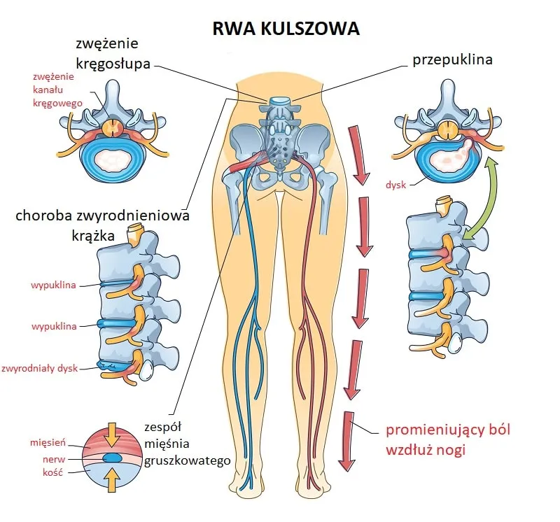 nerw kulszowy anatomia b&oacute;l schemat