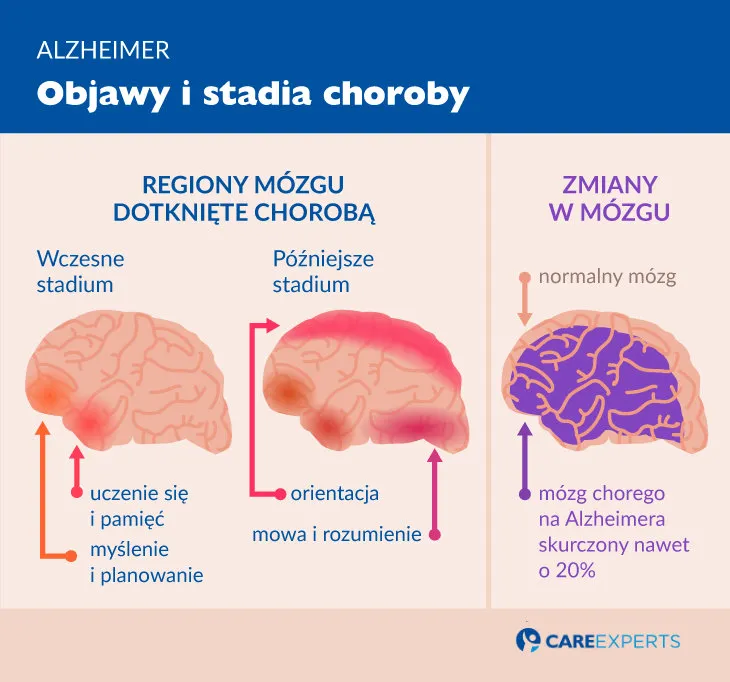 Zdjęcie Czy Alzheimer to choroba psychiczna? Prawda o demencji i jej objawach