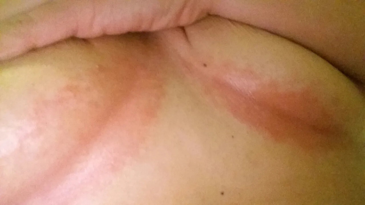 Zdjęcie Jak wygląda grzybica pod biustem - objawy i ważne sygnały ostrzegawcze