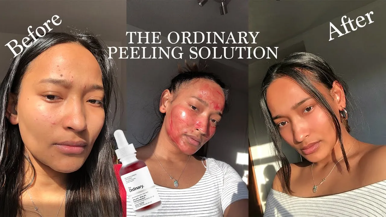 Zdjęcie Jak stosować czerwony peeling The Ordinary: 7 kluczowych zasad