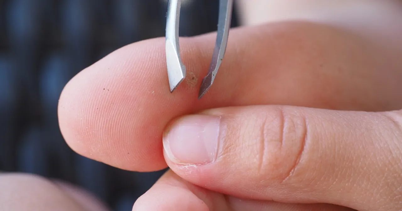 Zdjęcie Jak wyciągnąć drzazgę spod paznokcia - skuteczne metody i porady