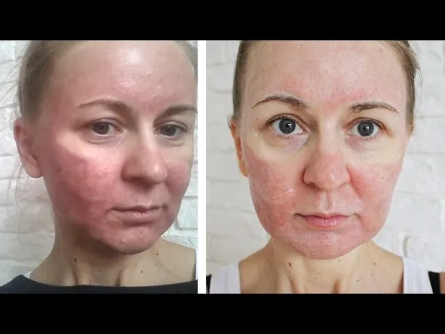 Zdjęcie Jak często stosować laser frakcyjny, aby uzyskać najlepsze efekty?