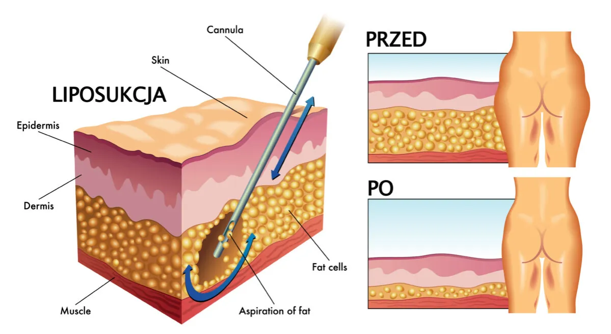 liposukcja obszary zabiegowe