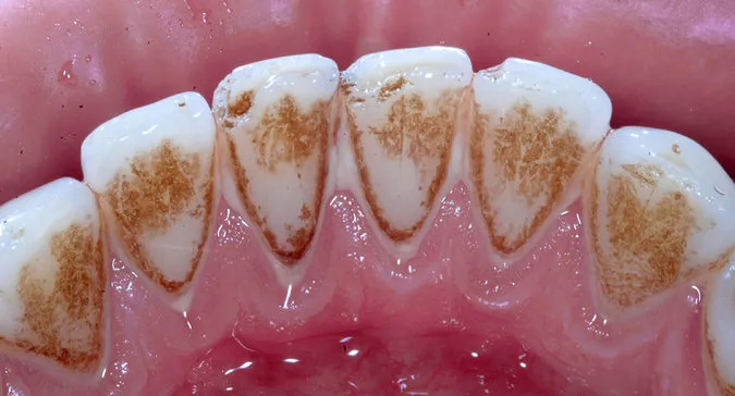 Próchnica i kamień nazębny na zębach