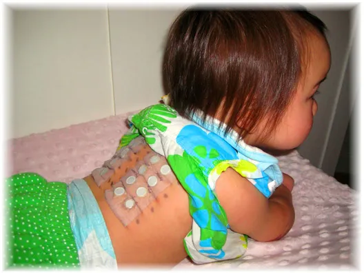 testy alergiczne z krwi niemowlę